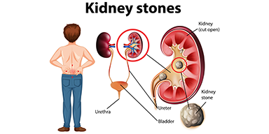 Kidney Stone Treatment Banner
